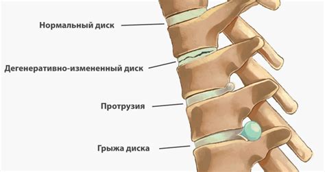 Гимнастика Норбекова для шейного отдела позвоночника: упражнения для шеи