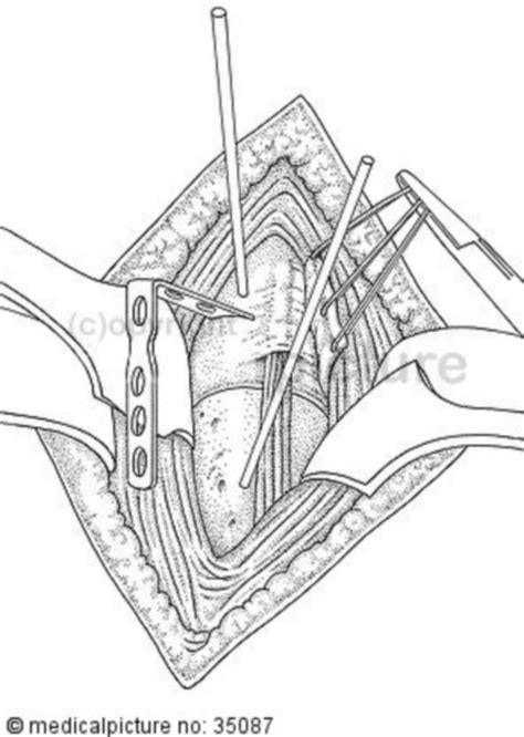 Shoulder joint surgery - DocCheck