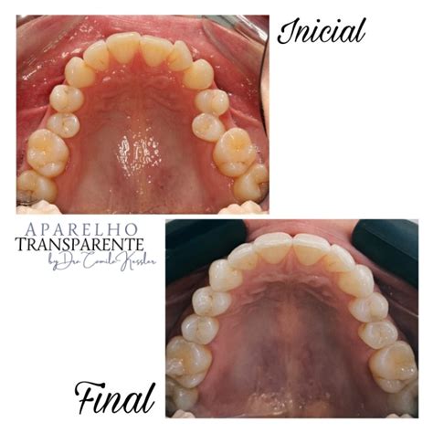 Dente Trincado Antes E Depois - Invisalign Antes E Depois Da Mordida Invisalign: O Guia Completo Para