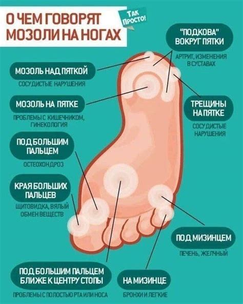 Как вылечить стержневую сухую мозоль в домашних условиях