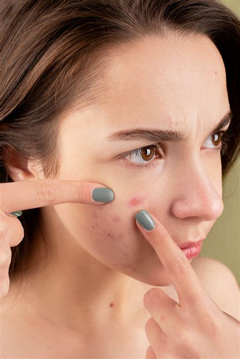 Should I Leave My Pimples Alone?