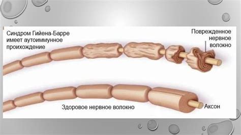 Синдром Гийена-Барре. Синдром Миллера-Фишера - презентация онлайн