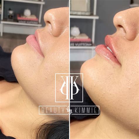 HYALURON PEN LIP FILLER | Lip fillers, Lips, Makeup looks