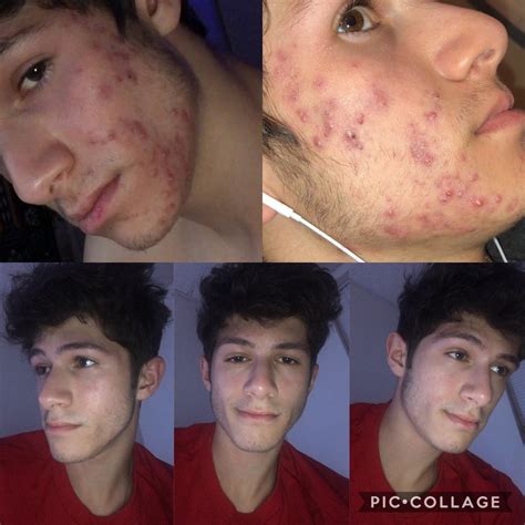 [Acne] Does Clindamycin Benzoyl Peroxide cause purging? : r