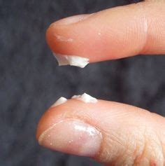 White Clumpy Discharge