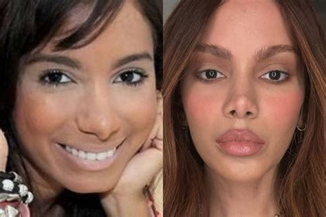Anitta Antes E Depois Da Harmonização Facial - Relembre o antes e depois dos famosos pós procedimentos estéticos ...