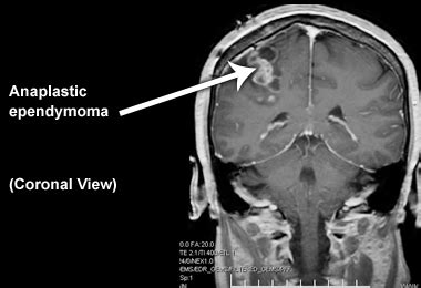 Adult Ependymoma Images | CERN Foundation