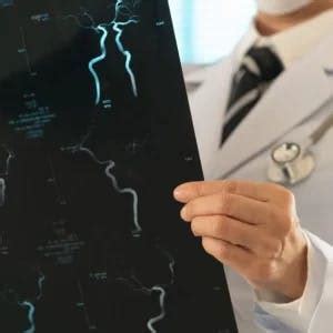 mca stroke  symptoms treatment