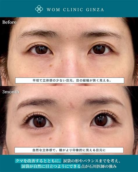 目の下のクマはなぜできる？原因とそれぞれの対処法を解説