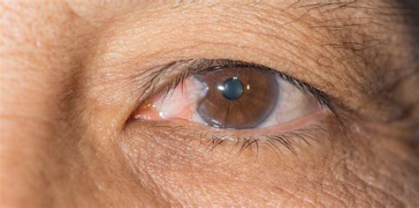 prism eyedrop study  pterygium surfers eye southern eye specialists