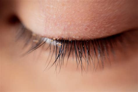 ¿Qué es la blefaritis? Tipos, Causas y Tratamiento