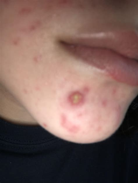 Better patches will eventually stop the need to pop cystic pimple 6