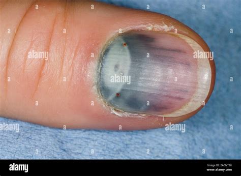 Close-up of bruising under the fingernail (subungual haematoma) in a 30 ...