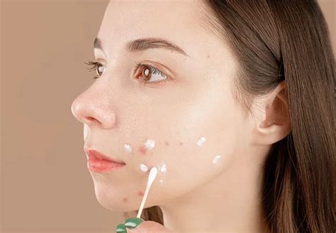 wajah berjerawat parah simak tips berikut  mengatasinya