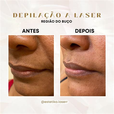 Depilação No Rosto A Laser - Depilacao A Laser Antes E Depois Do Rosto