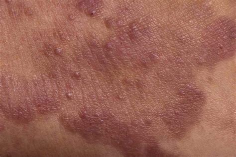 Lymphoma Rash: Diagnosis, Symptoms, and Treatment