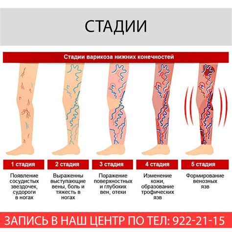 Чем опасна варикозная болезнь