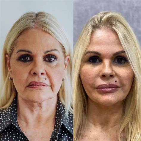 Lifting Facial Antes E Depois