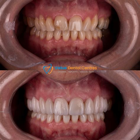 Before and After Gallery | Value Dental Centres