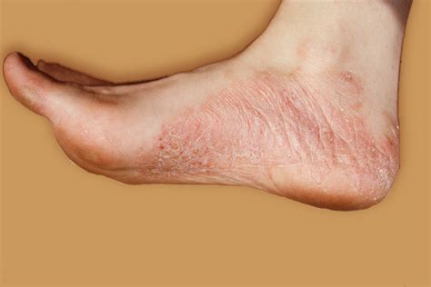 Guselkumab Effective for Long-Term Treatment of Moderate to Severe ...