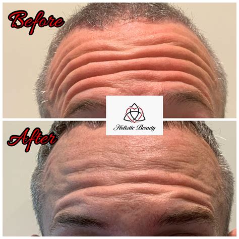 Wrinkle Relaxers - Holistic Beauty