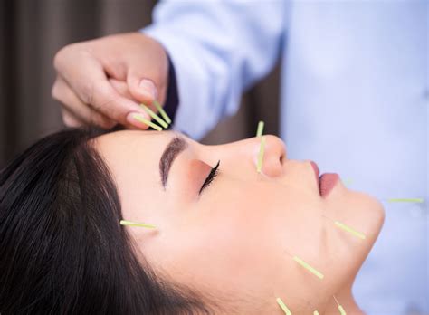 Acupuncture in Edison, NJ | Backsmart Wellness Center