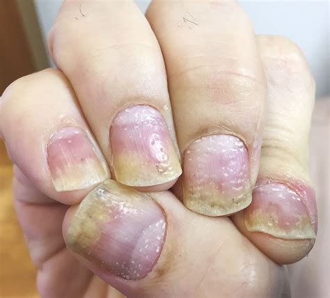 Pitted Nails as Sign of Psoriasis