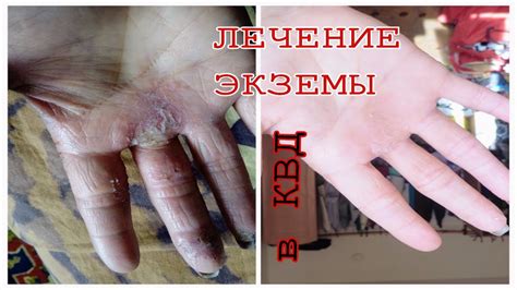 ЭКЗЕМА дегидротозная. ЛЕЧЕНИЕ в КожВенДиспансере - YouTube