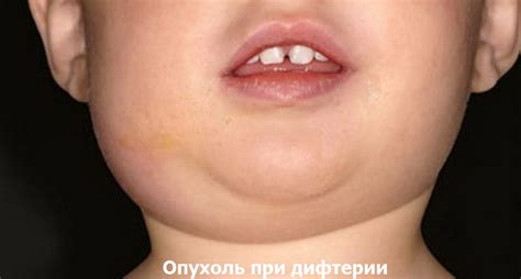 Дифтерия - симптомы, лечение, формы у детей и взрослых