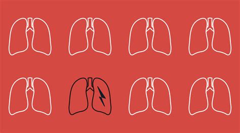 TB Continues to Prey on Underserved US-born Americans | FSI