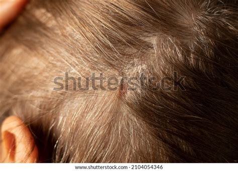 Dry Itchy Scalp Scabs On Womans Stock Photo 2104054346 | Shutterstock