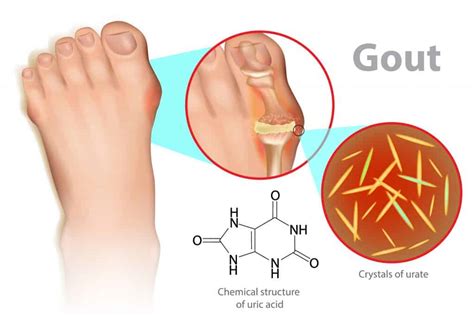 gout  feet  ankles  william christy blog