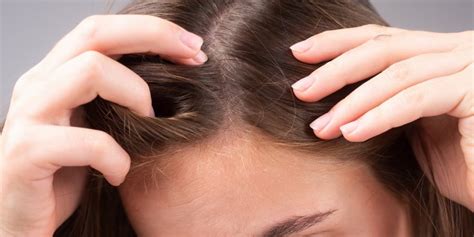 What Is Receding Hairline And How To Prevent It