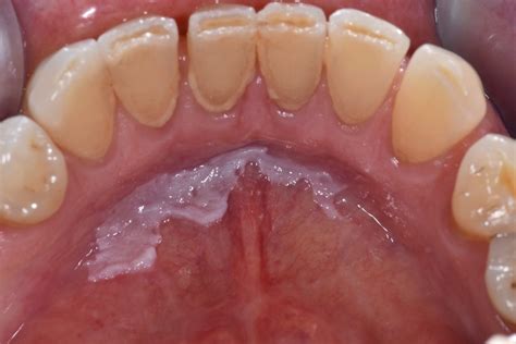 Leucoplasia O Que É - Leucoplasia Oral – OPMDCARE