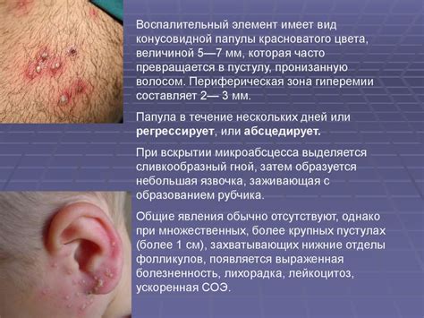 Инфекция кожи и подкожной клетчатки - презентация онлайн
