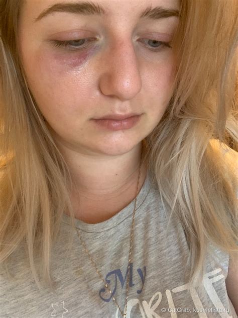 чем хорошо замазать синяки под глазами