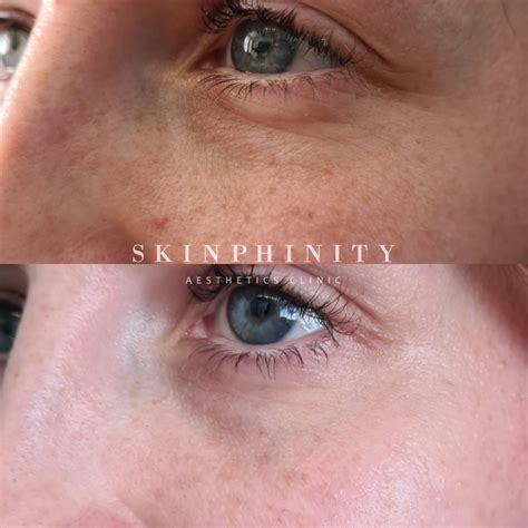Under eye mesotherapy - an alternative to fillers? — Skinphinity