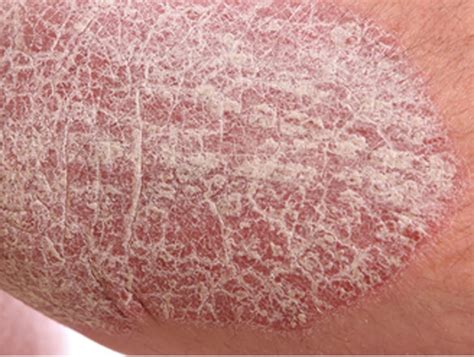 Psoriasis:Type, Causes, Symptoms, and Treatments