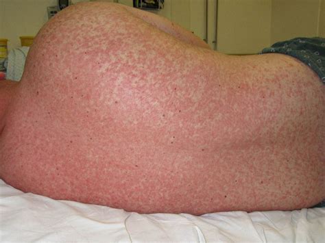 Measles Rash: Pictures, First Signs, How Long It Lasts