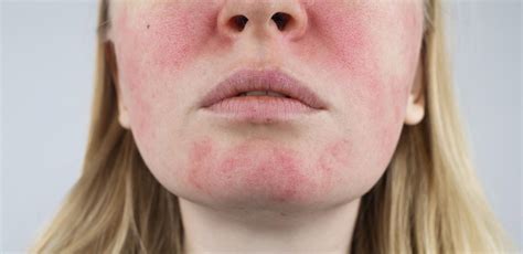 Facial eczema : understanding causes, treatment, and care