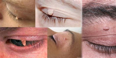 Filiform Wart On Eyelid
