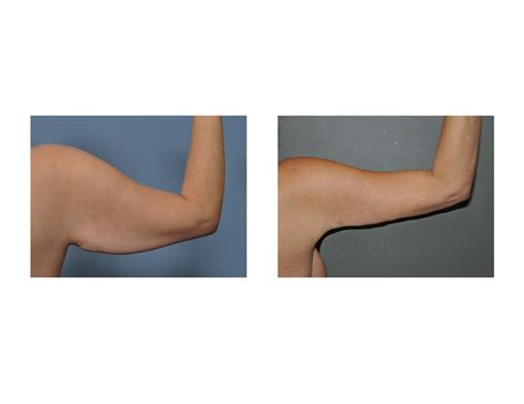 The Differing Types and Indications for Arm Lift Surgery - Explore ...