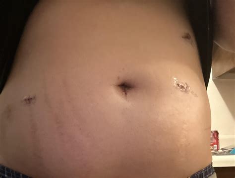 Hurts… rip my belly button : r/gallbladders