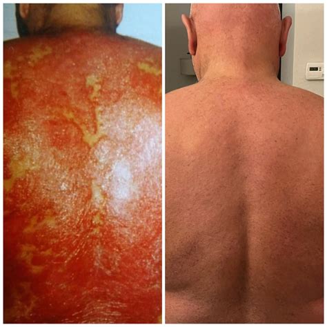 Psoriasis Association - #Psoriasis on the feet can be irritating