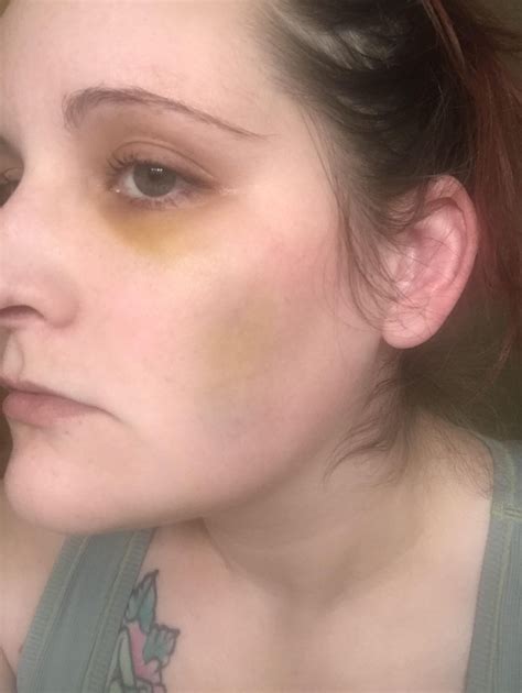 Dark bump under skin after being punched in the face by my brother