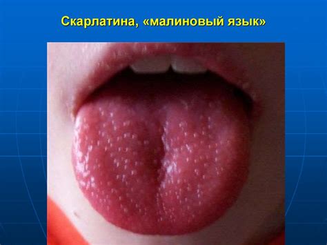 Скарлатина у детей - презентация онлайн