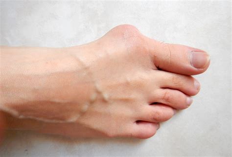 Hallux Valgus: Symptoms, Causes, and Treatments - Health