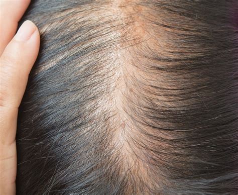 Women Alopecia: Hair Loss & Microneedling - DermapenWorld