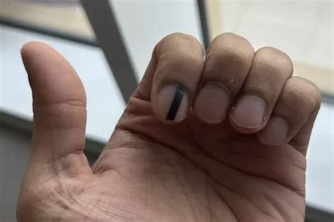 Linha Preta Na Unha Como Tirar - Internauta compartilha foto de “linha preta” na unha e médicos fazem ...