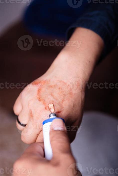 Burn Injury Stock Photos, Images and Backgrounds for Free Download